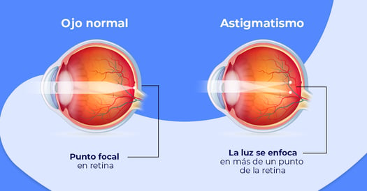 astigmatismo-que-es